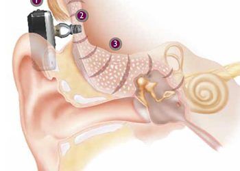 Todo lo que las familias deben saber sobre los implantes BAHA en niños